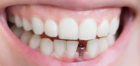 Smile with dental implant