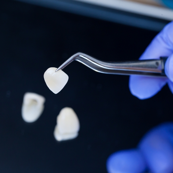 Dentist holding a veneer with tweezers