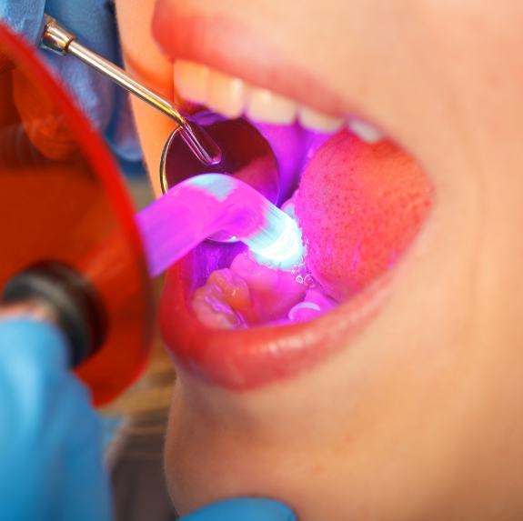 Close up of dental patient receiving cosmetic bonding on lower front tooth