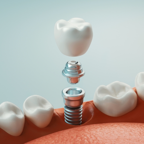 Illustrated dental implant being placed into the lower jawbone