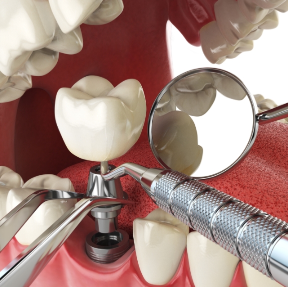 Illustrated dental implant with abutment and crown being placed into the jaw