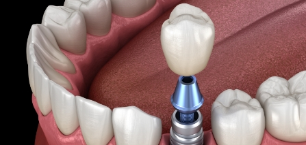 Illustrated dental crown being fitted onto a dental implant