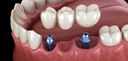 Illustrated dental bridge being fitted onto two dental implants