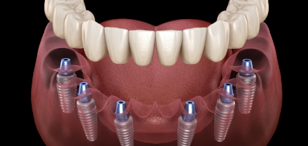 Illustrated full denture being fitted onto six dental implants