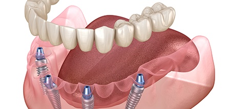 a digital illustration showing how implant dentures work