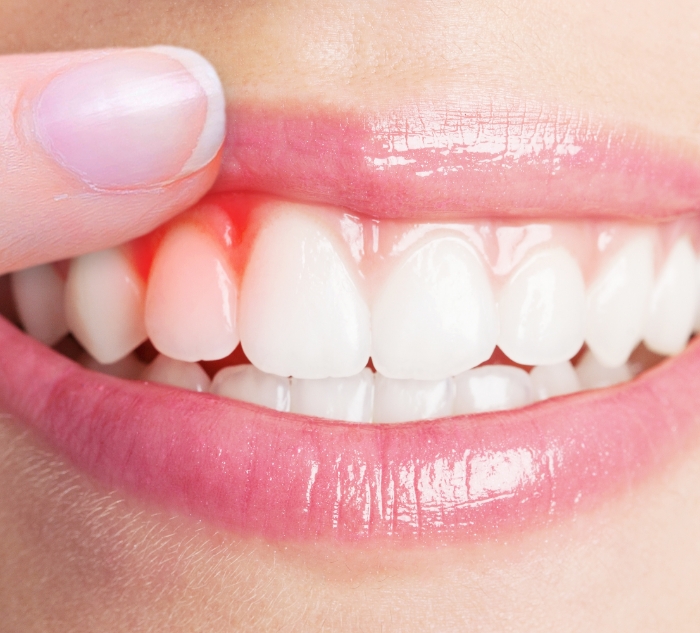 Person pointing to red spot in their gums before gum disease treatment