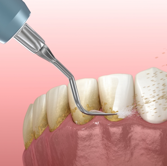 Illustrated dental scaler removing plaque buildup from teeth