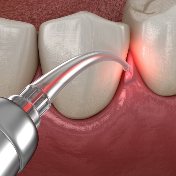 Illustrated dental laser treating gum disease