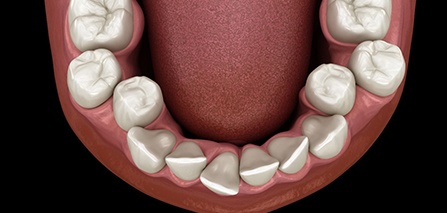 Illustration of crowded teeth