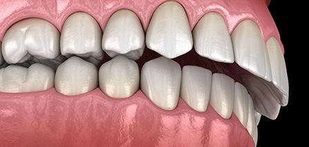 Illustration of an overbite