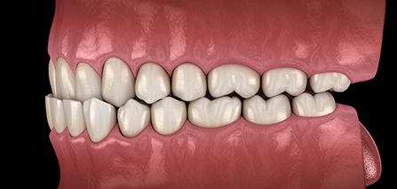 Illustration of an underbite