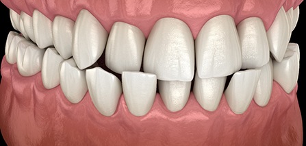 Illustration of crossbite