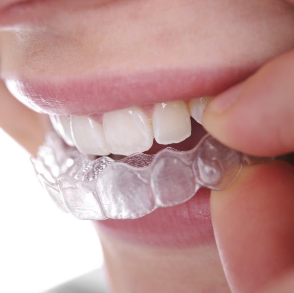 Close up of person placing Invisalign aligner over their teeth