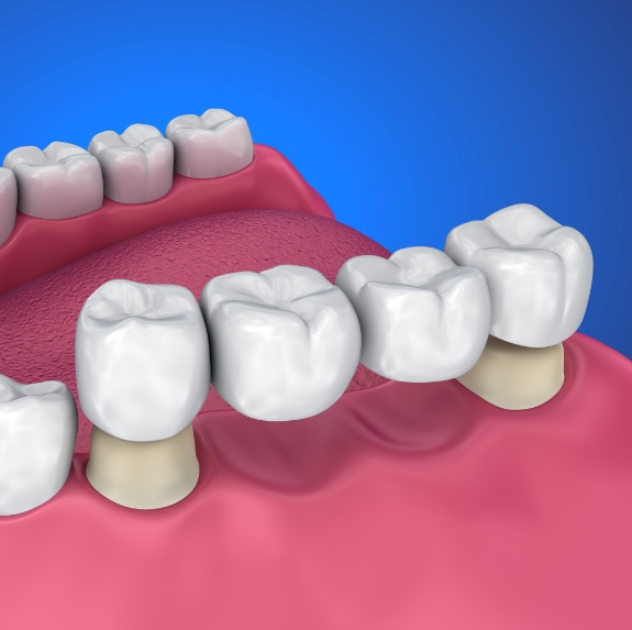 Illustrated dental bridge replacing four missing teeth