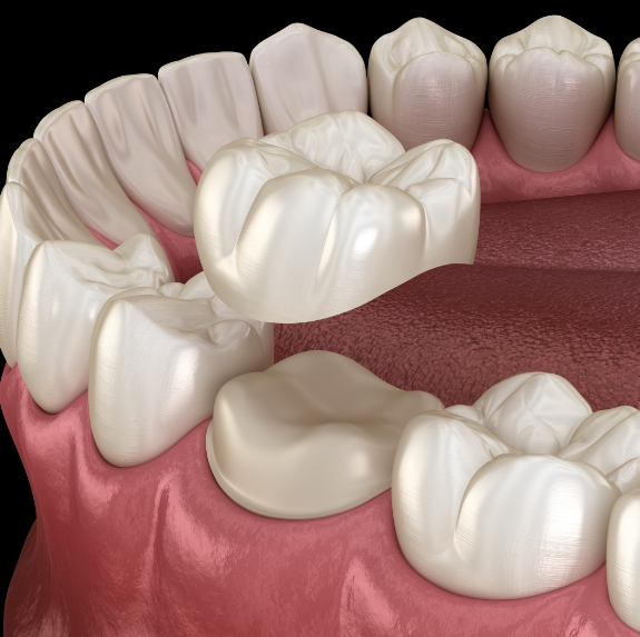 Illustrated dental crown being fitted over a tooth