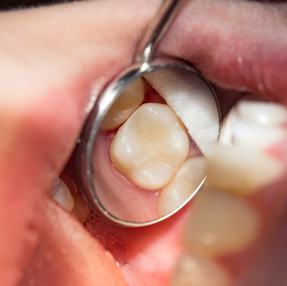 Close up of dental mirror reflecting a white tooth