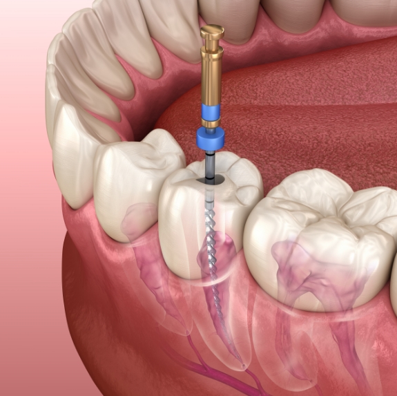 Illustrated dental instrument cleaning inside of tooth during root canal treatment