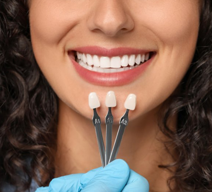 Dentist comparing three dental veneers to a patient’s teeth