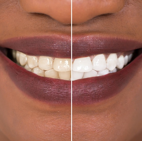 Closeup of patient's smile before and after teeth whitening
