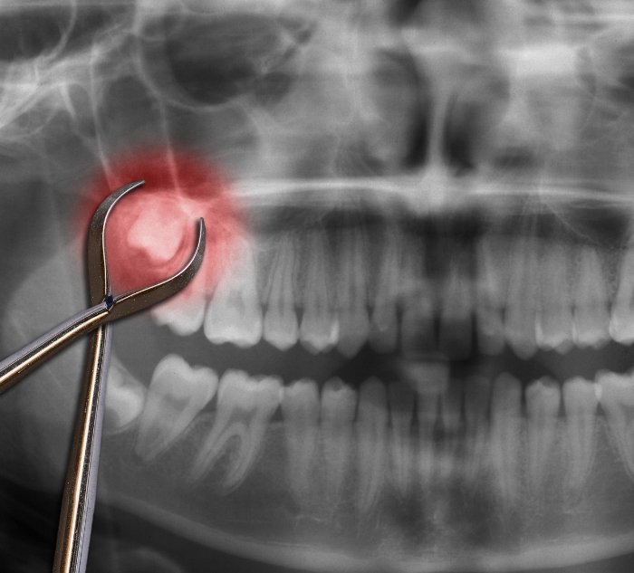 Dental x ray with an impacted wisdom tooth highlighted red