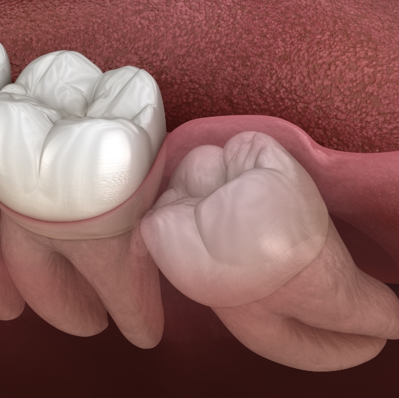 Illustrated wisdom tooth pressing against adjacent tooth