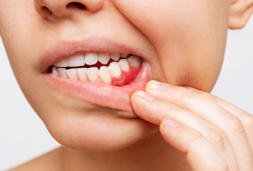 Woman showing inflamed gums